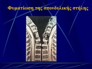 Φυματίωση της σπονδυλικής στήλης
 