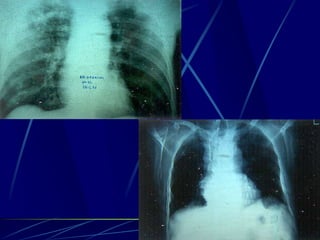 Spine infections 2009