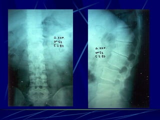 Spine infections 2009