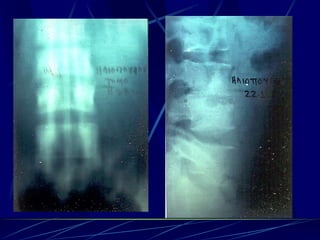 Spine infections 2009