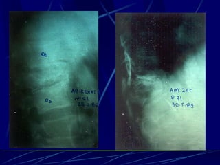 Spine infections 2009