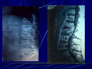 Spine infections 2009
