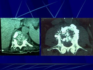 Spine infections 2009