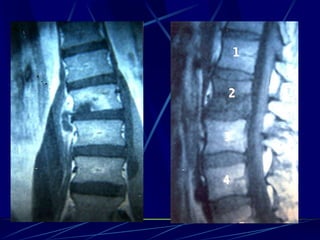 Spine infections 2009
