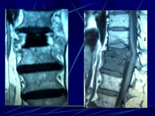 Spine infections 2009