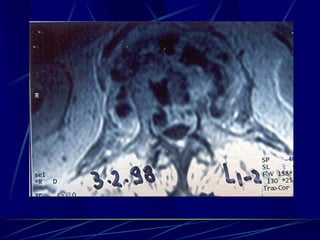 Spine infections 2009