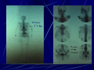 Spine infections 2009