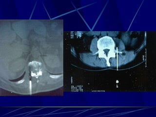 Spine infections 2009