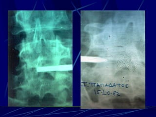 Spine infections 2009