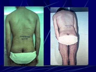 Spine infections 2009