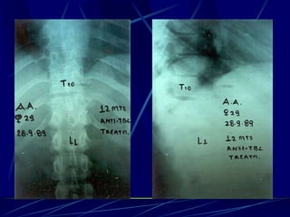 Spine infections 2009