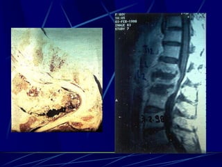 Spine infections 2009