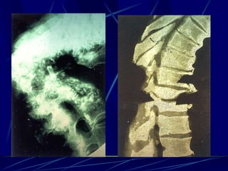 Spine infections 2009