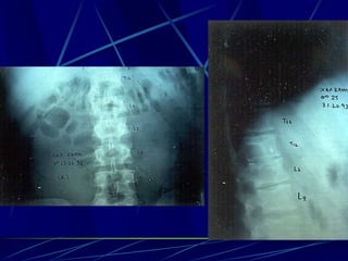 Spine infections 2009