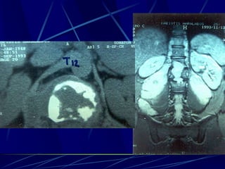 Spine infections 2009