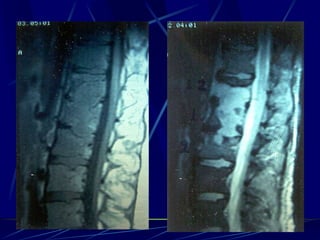 Spine infections 2009