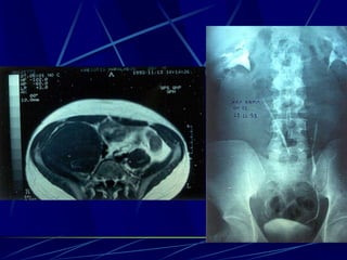 Spine infections 2009