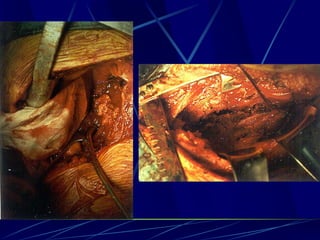 Spine infections 2009