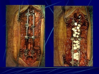 Spine infections 2009