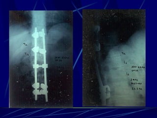 Spine infections 2009