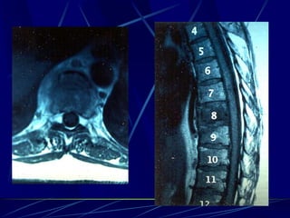 Spine infections 2009