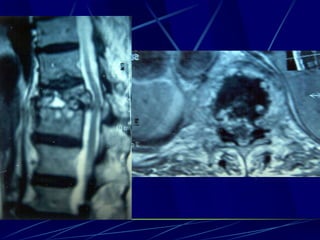 Spine infections 2009