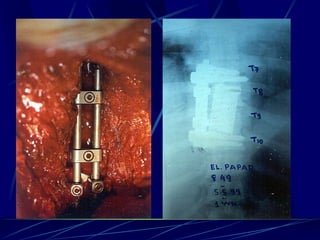 Spine infections 2009