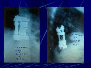 Spine infections 2009