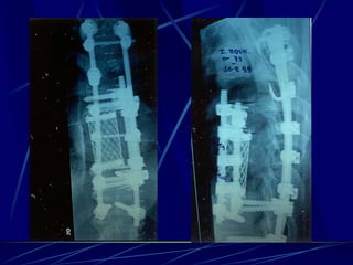 Spine infections 2009