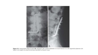 Spine Instrumentation.pptx