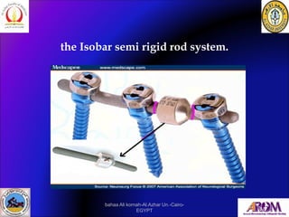 the Isobar semi rigid rod system.
bahaa Ali kornah-Al.Azhar Un.-Cairo-
EGYPT
 
