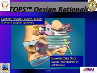 Surrounding Boot
Avoids impingement of
soft tissues
Pedicle Screw Based Design
Standard surgical approach
bahaa Ali kornah...