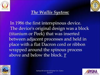 The Wallis System:
In 1986 the first interspinous device.
The device's original design was a block
(titanium or Peek) that...