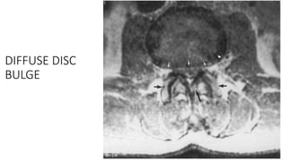 Diffusely Bulging Disc spine mri-111122²2²21111122222222222.pptx
