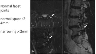 spine mri-111122²2²21111122222222222.pptx