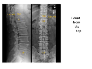 Spinal Presentation Spine presentation and spinal surgery management | PDF