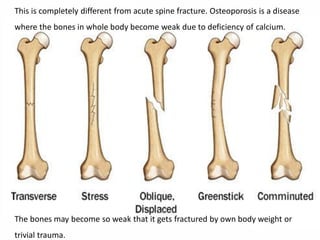 This is completely different from acute spine fracture. Osteoporosis is a disease
where the bones in whole body become weak due to deficiency of calcium.
The bones may become so weak that it gets fractured by own body weight or
trivial trauma.
 