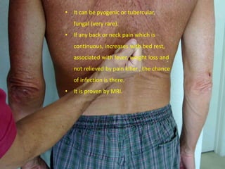 • It can be pyogenic or tubercular,
fungal (very rare).
• If any back or neck pain which is
continuous, increases with bed rest,
associated with fever, weight loss and
not relieved by pain killer , the chance
of infection is there.
• It is proven by MRI.
 