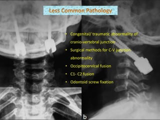 • Congenital/ traumatic abnormality of
cranio-vertebral junction
• Surgical methods for C-V junction
abnormality
• Occipitocervical fusion
• C1- C2 fusion
• Odontoid screw fixation
 