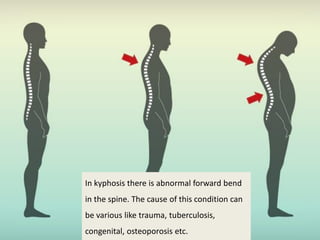 In kyphosis there is abnormal forward bend
in the spine. The cause of this condition can
be various like trauma, tuberculosis,
congenital, osteoporosis etc.
 
