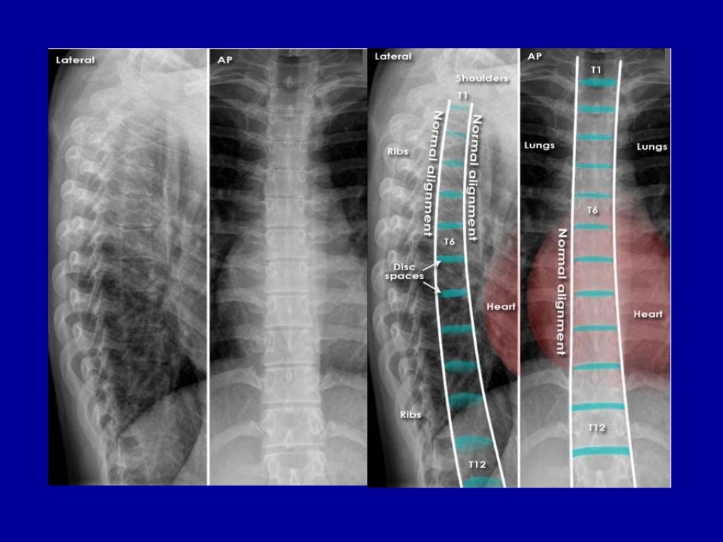 Spine radiography
