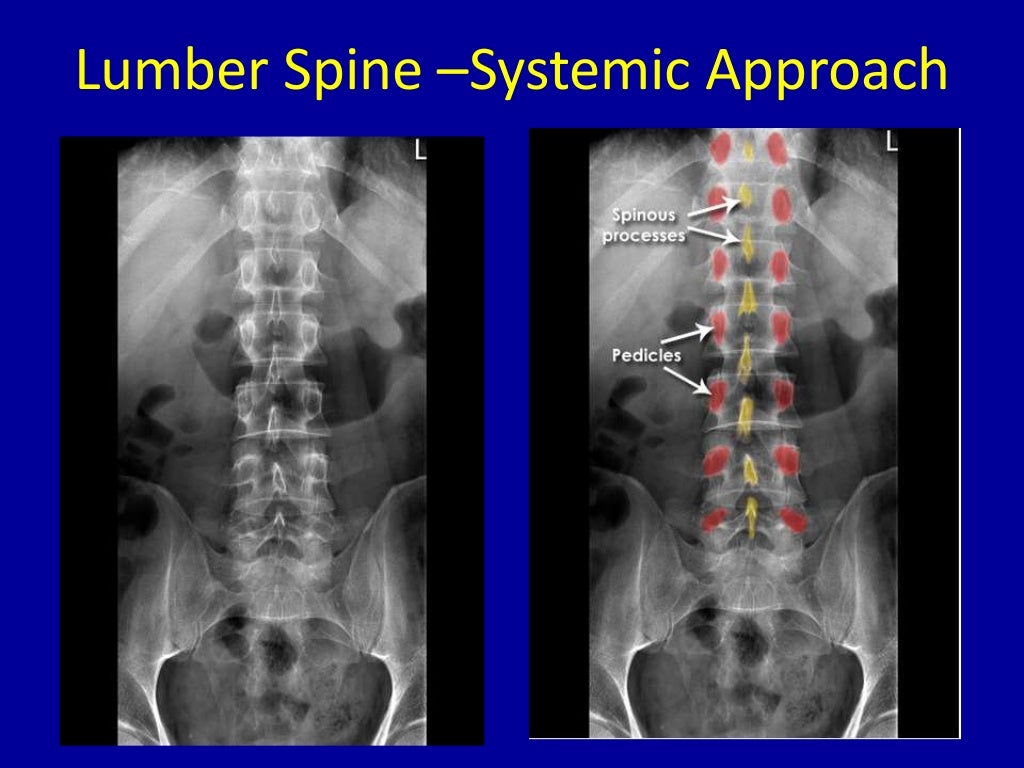 Spine radiography