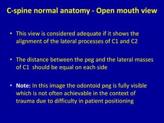C-spine normal anatomy - Open mouth view
• This view is considered adequate if it shows the
alignment of the lateral processes of C1 and C2
• The distance between the peg and the lateral masses
of C1 should be equal on each side
• Note: In this image the odontoid peg is fully visible
which is not often achievable in the context of
trauma due to difficulty in patient positioning
 