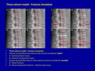 • Three column model - Fracture simulation
• Injuries 1 and 2 affect one column only and are considered 'stable'
• 1 - Spinous process injury
• 2 - Anterior compression injury
• Injuries 3 and 4 affect two or more columns and are considered 'unstable'
• 3 - 'Burst' fracture
• 4 - Flexion-distraction fracture - 'Chance' type injury
Three column model - Fracture simulation
 