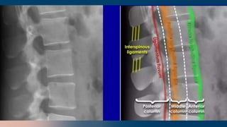 Cd Spine Example SPINE RADIOLOGY DR JEAN PAUL NKUNDIMANA.pptx