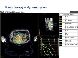 Tomotherapy – dynamic jaws
 