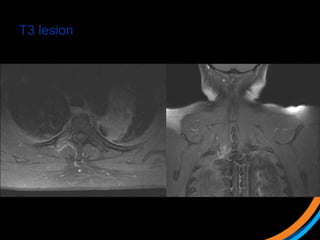 T3 lesion
 