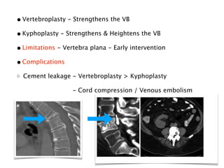 •Vertebroplasty - Strengthens the VB
•Kyphoplasty - Strengthens & Heightens the VB
•Limitations - Vertebra plana - Early intervention
•Complications
Cement leakage - Vertebroplasty > Kyphoplasty
- Cord compression / Venous embolism
 