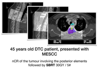 45 years old DTC patient, presented with
MESCC
nCR of the tumour involving the posterior elements
followed by SBRT 30GY / 5#
 