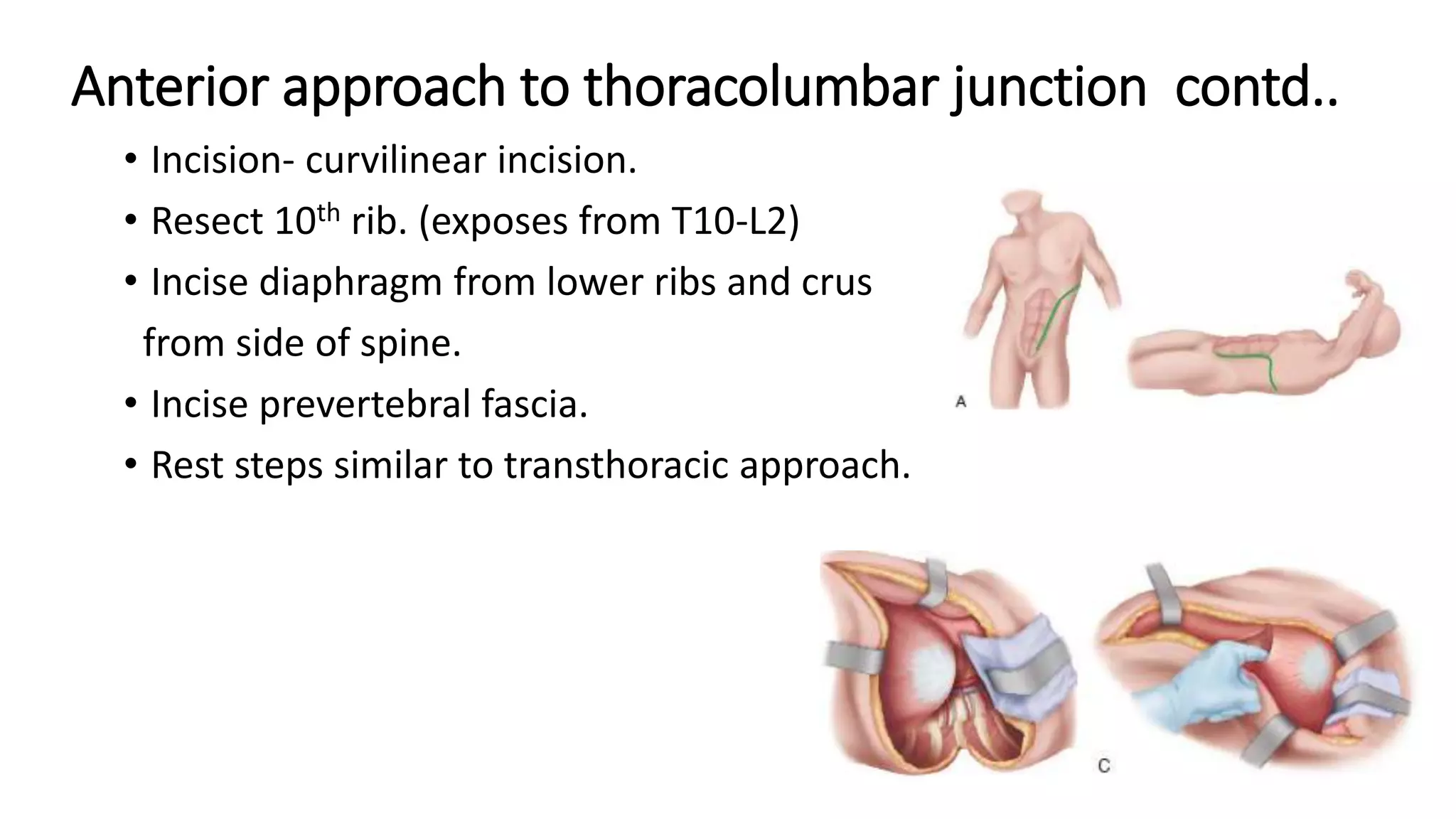 Surgical approaches to spine | PPTX